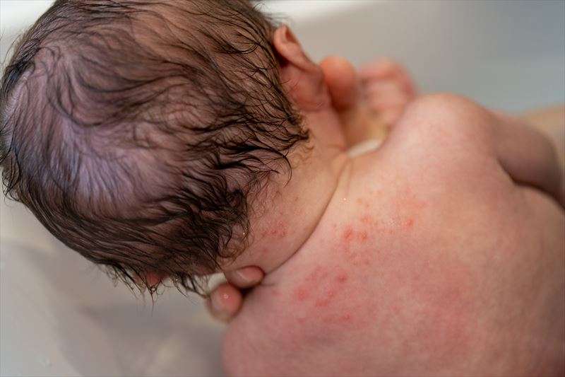 赤ちゃんに起こる肌トラブルとは？